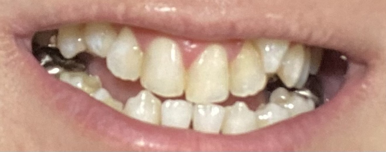 after photo: ホワイトニング