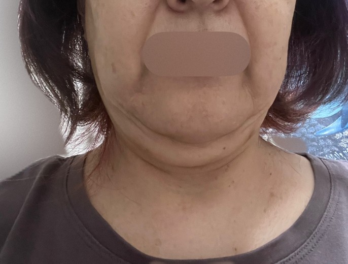 after photo: 脂肪溶解注射(顔)