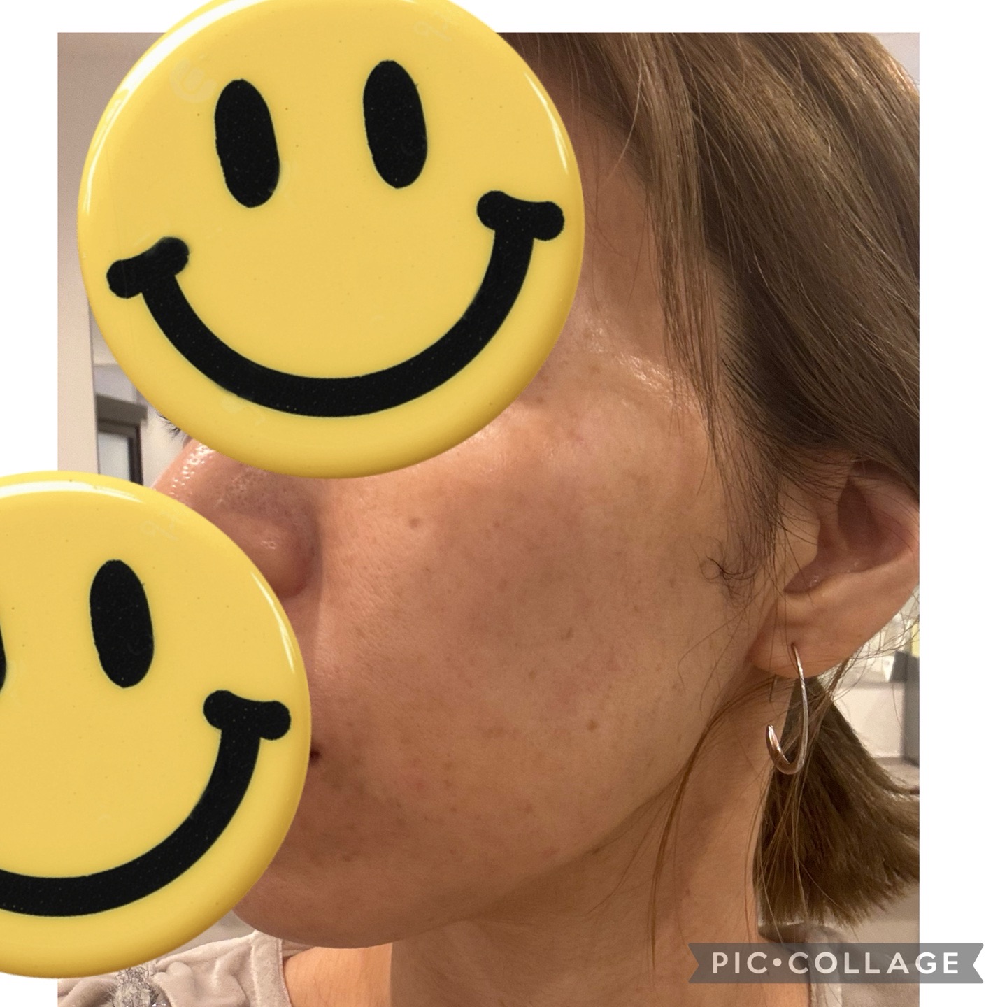 HIFU全顔650shot ウルトラフォーマーMPT【11月30日迄にご予約頂いた方