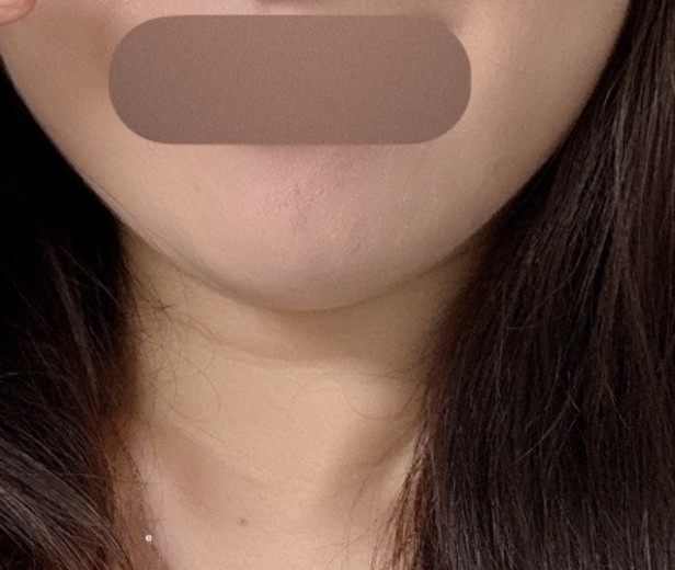 after photo: 인모드리프팅, 윤곽주사, 사각턱보톡스