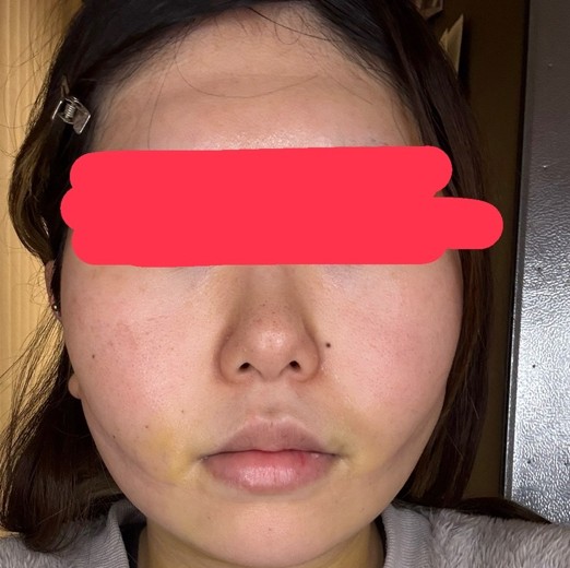 after photo: 糸リフト, 脂肪吸引(顎下), 脂肪吸引(顔), 脂肪吸引(頬)