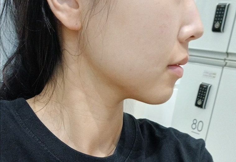 before photo: 인모드리프팅, 윤곽주사