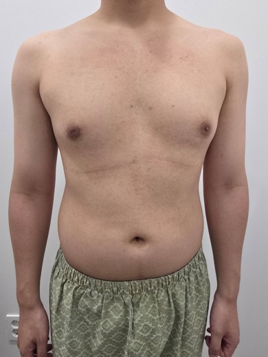 before photo: 여유증수술