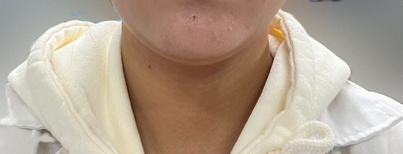 after photo: 윤곽주사