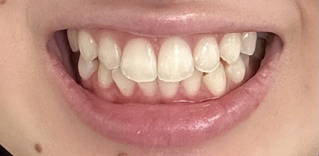 after photo: ホワイトニング