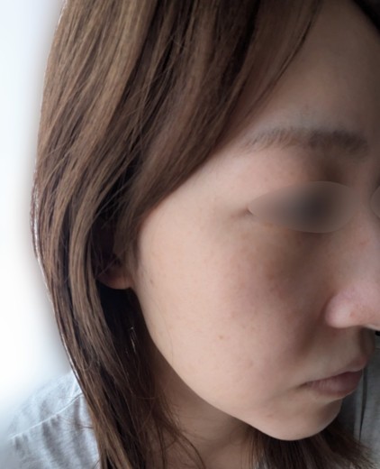after photo: IPL(光/フォト治療), ピーリング