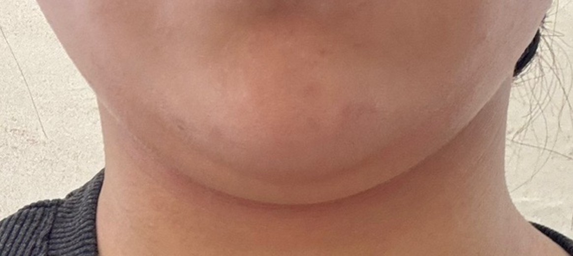 before photo: 脂肪溶解注射(顔)