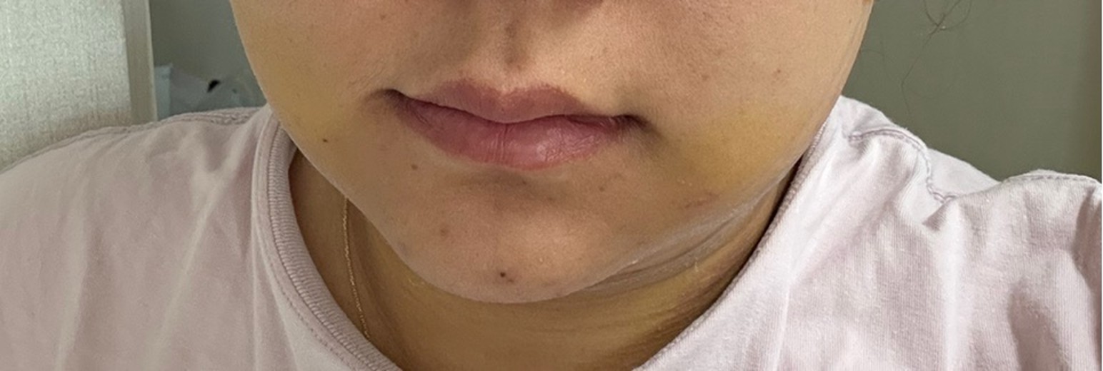 after photo: 이중턱지방흡입, 얼굴지방흡입, 이중턱근육묶기