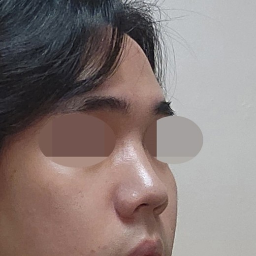 before photo: 코끝(자가연골)