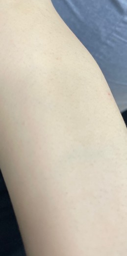 after photo: 팔제모, 종아리제모