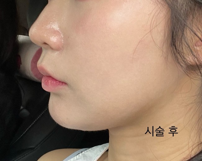 after photo: 리쥬란힐러