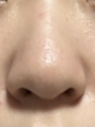 after photo: 小鼻ボトックス, 脂肪溶解注射(顔)