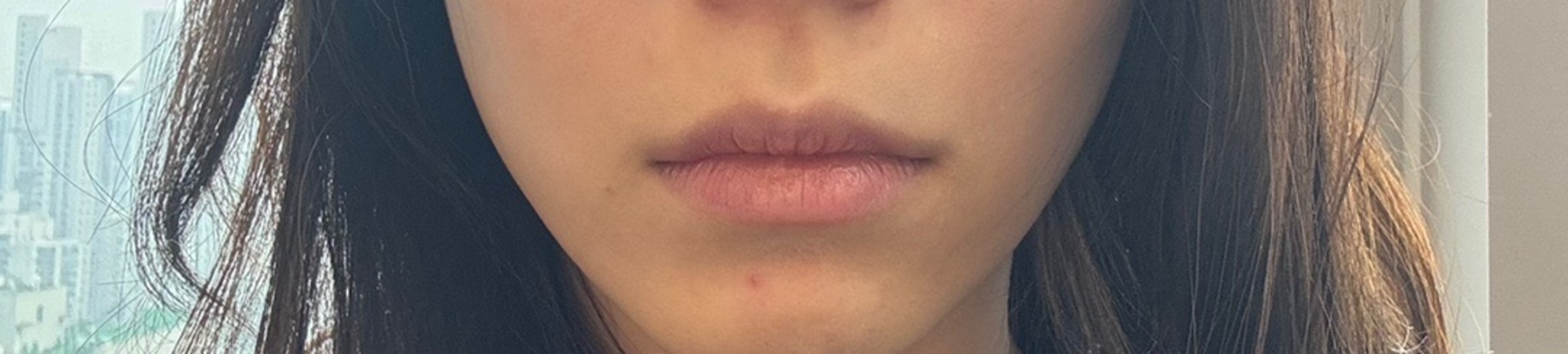 before photo: 입꼬리성형