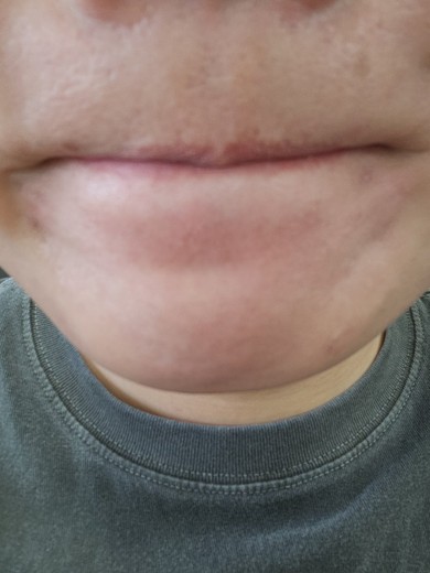 after photo: 아쿠아필링, 수염제모