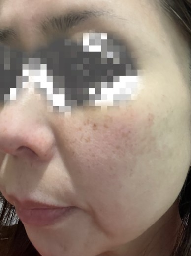 before photo: ピーリング, ルメッカ
