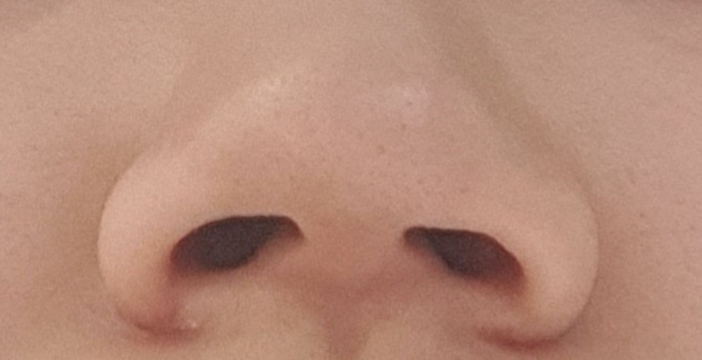 after photo: 콧볼축소