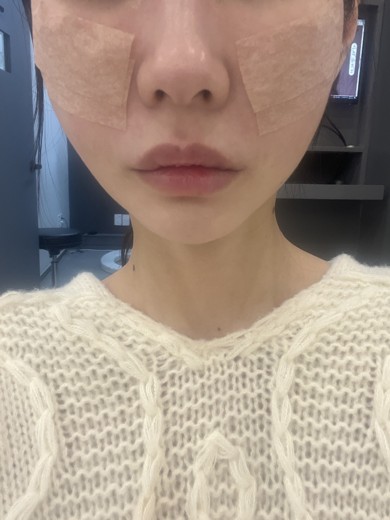 after photo: 실리프팅