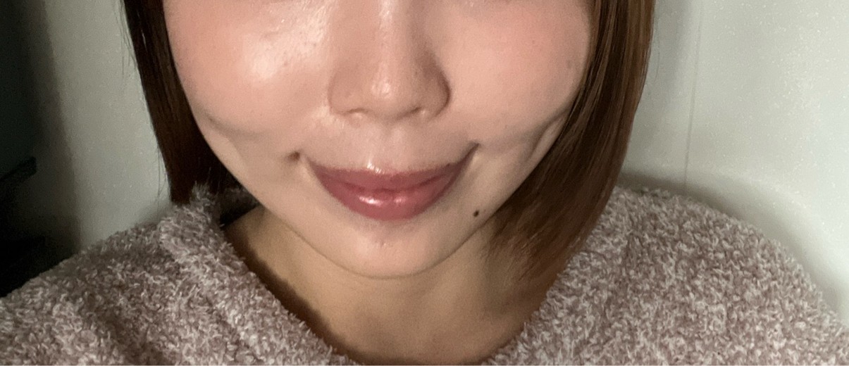 after photo: 脂肪溶解注射(顔)