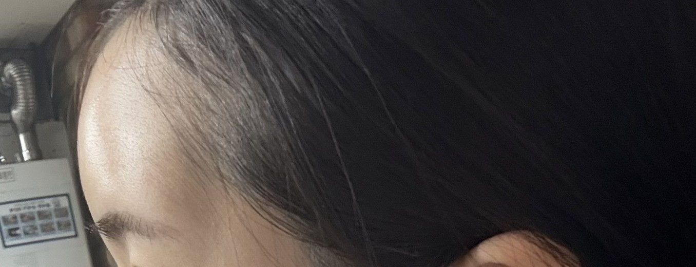 after photo: 이마필러