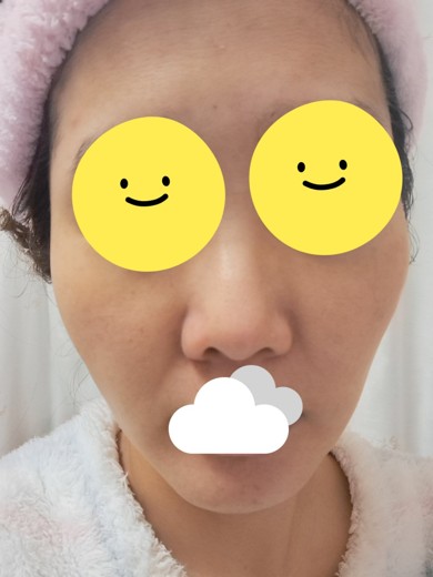 after photo: ピーリング, エレクトロポレーション, ルメッカ