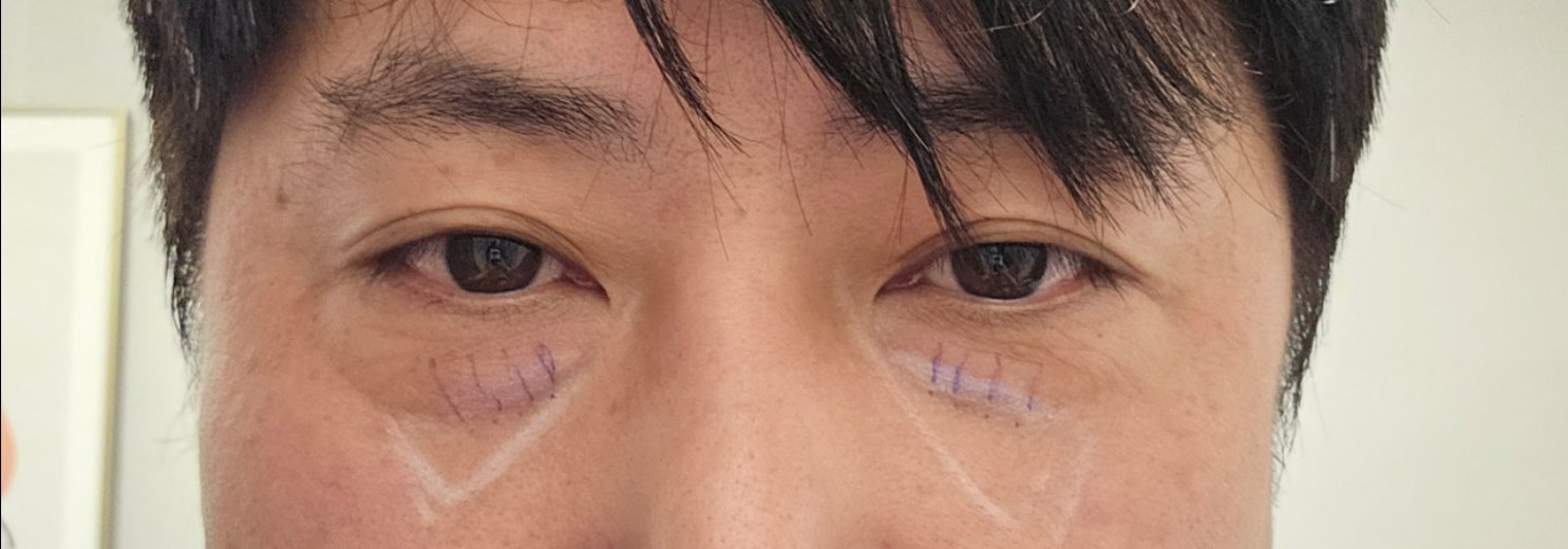 before photo: 눈밑지방재배치