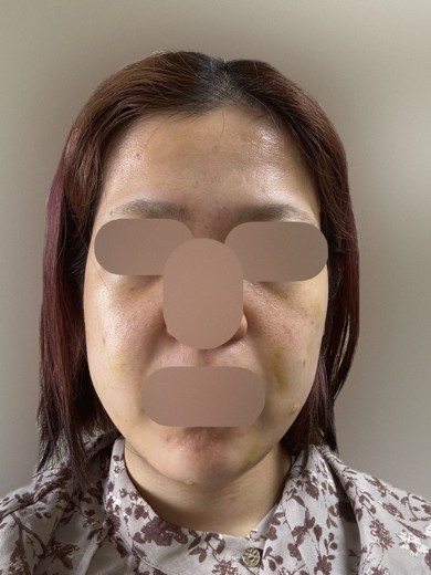 before photo: ピーリング, プラピール