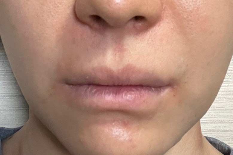 before photo: 脂肪溶解注射(顔)