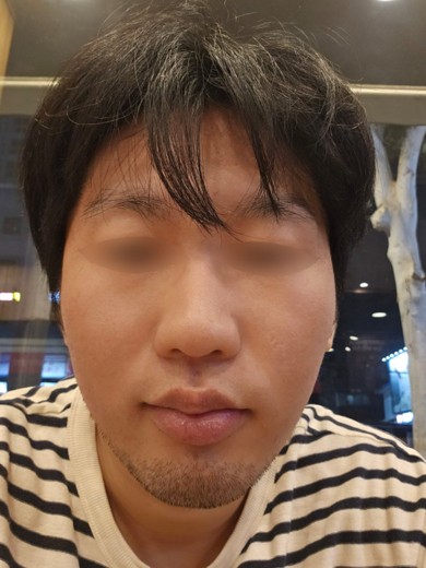 after photo: 아쿠아필링