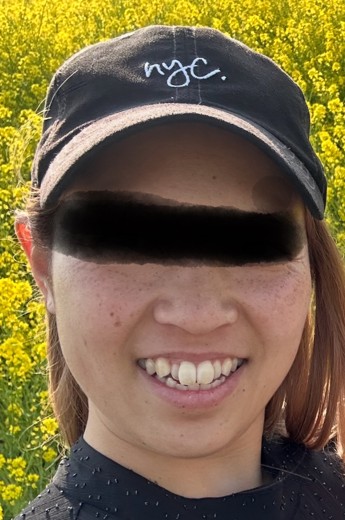 before photo: レーザートーニング