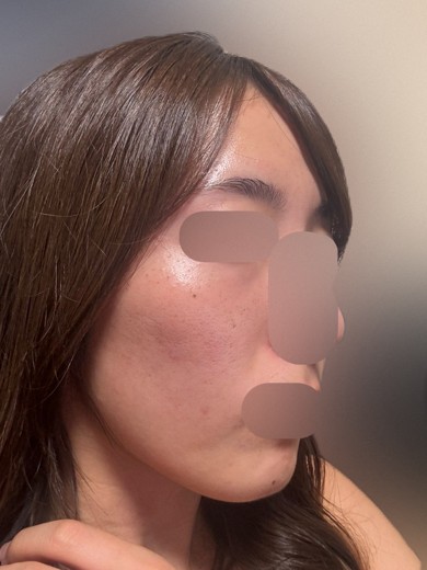 after photo: ルメッカ
