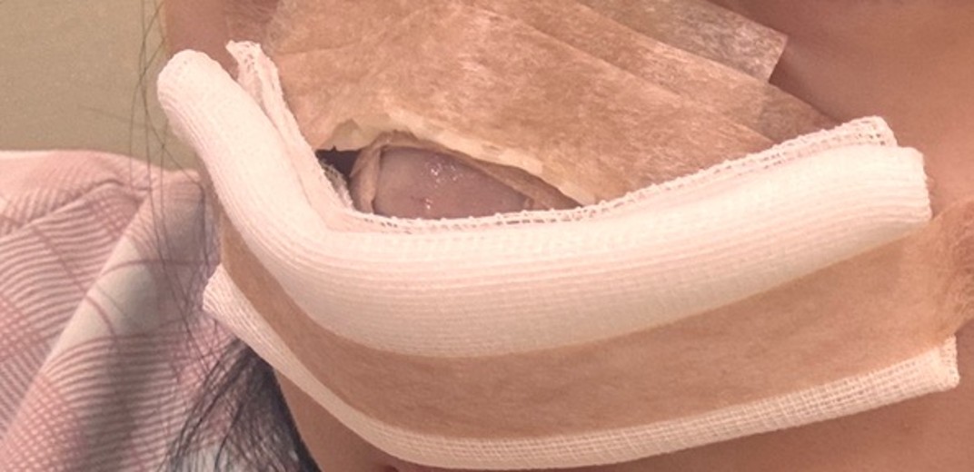 after photo: 콧대(보형물), 코끝(자가연골)