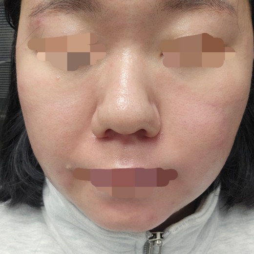 after photo: 아쿠아필링