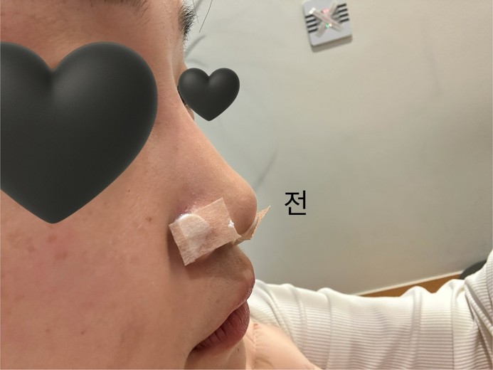 after photo: 코실리프팅