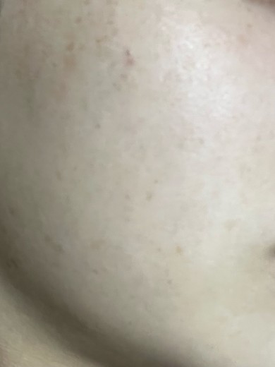after photo: 白玉注射・点滴