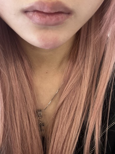 before photo: 턱필러, 턱끝보톡스, 턱끝필러