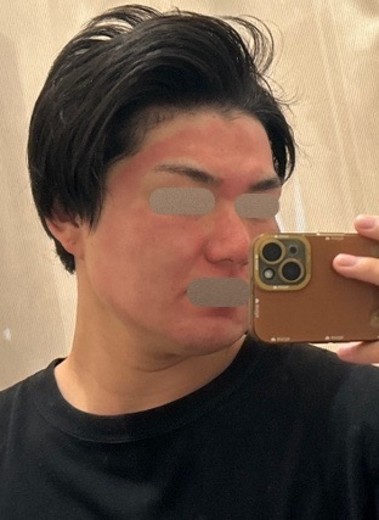 before photo: ダーマペン