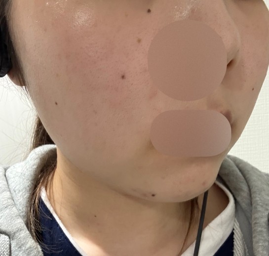 after photo: ピーリング