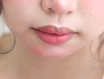 たらこ唇様確認用 症例写真】タラコ唇の人に、手術で上下の唇を薄くした症例：美容外科