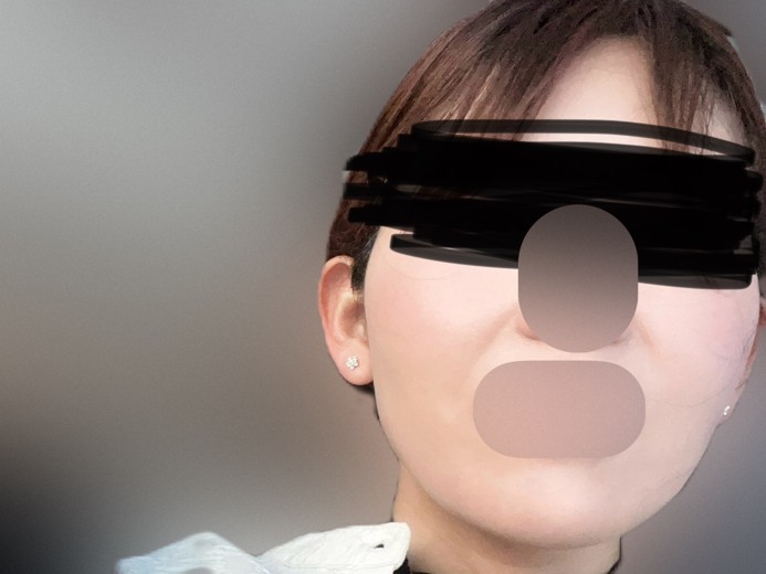 before photo: ハイフ(HIFU)