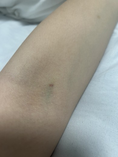 after photo: 白玉注射・点滴