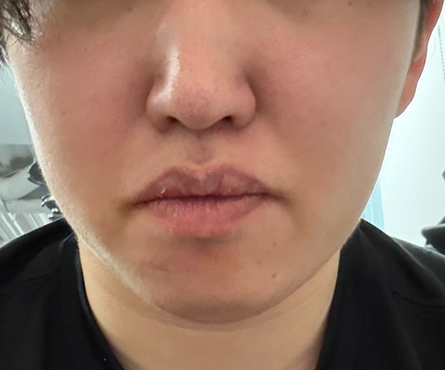 after photo: 脂肪溶解注射(顔)
