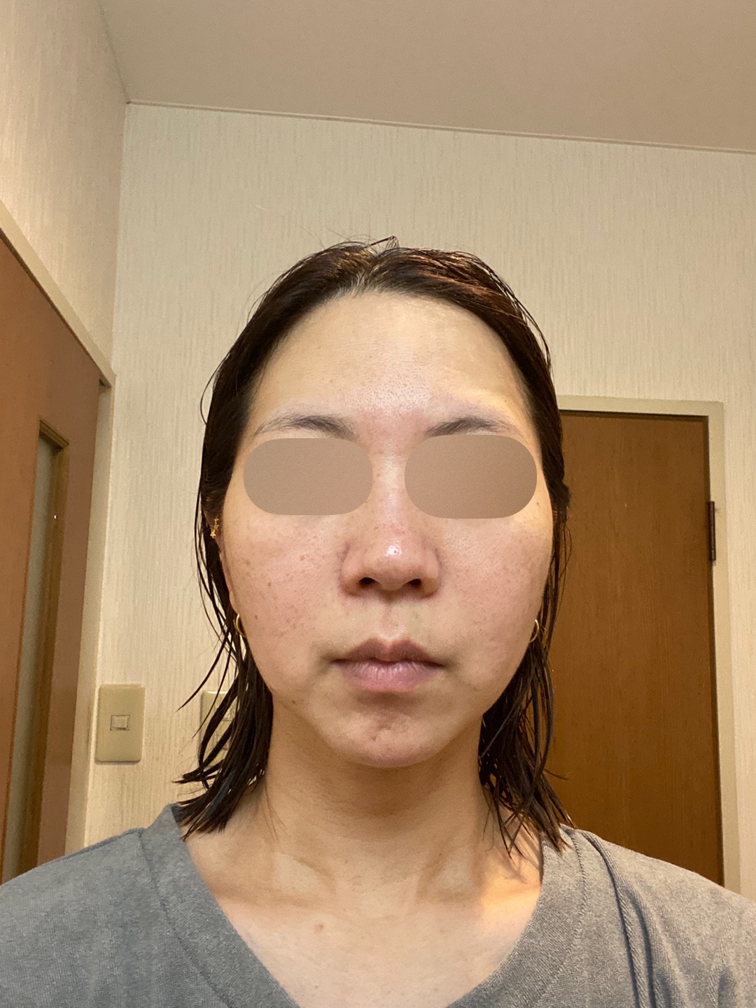 何度でも可】全顔シミ取り放題＋美顔レーザートーニング | ZX-CLINIC