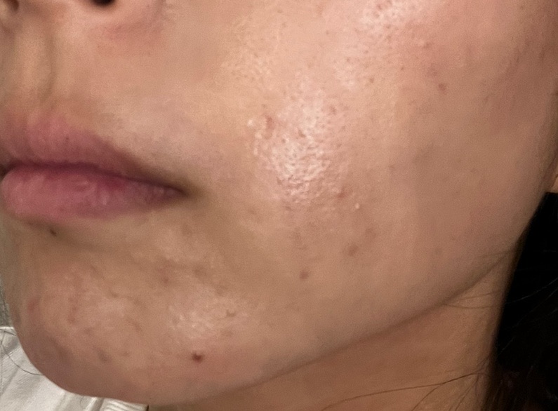 IPL（光治療）全顔2周 ｜ステラM22フォトフェイシャル【11月30日迄にご