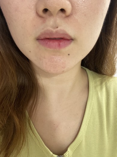 after photo: 슈링크리프팅