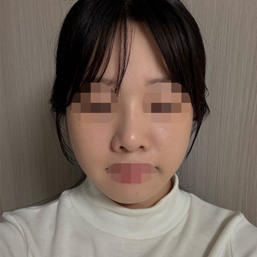 before photo: 콧볼축소