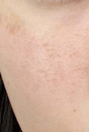 after photo: IPL(光/フォト治療), ピーリング, ルメッカ