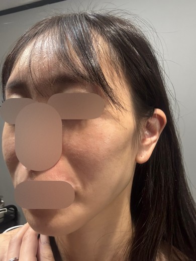 before photo: ルメッカ