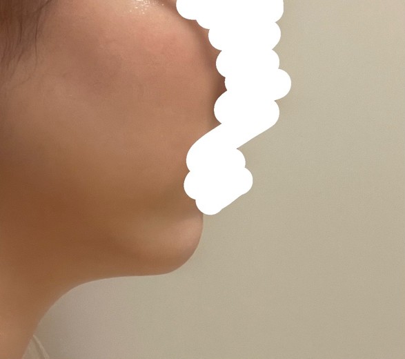 after photo: 脂肪吸引(顎下)