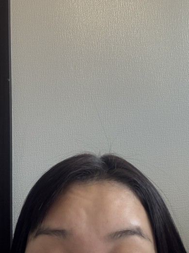 after photo: 眉間ボトックス, 額のしわボトックス