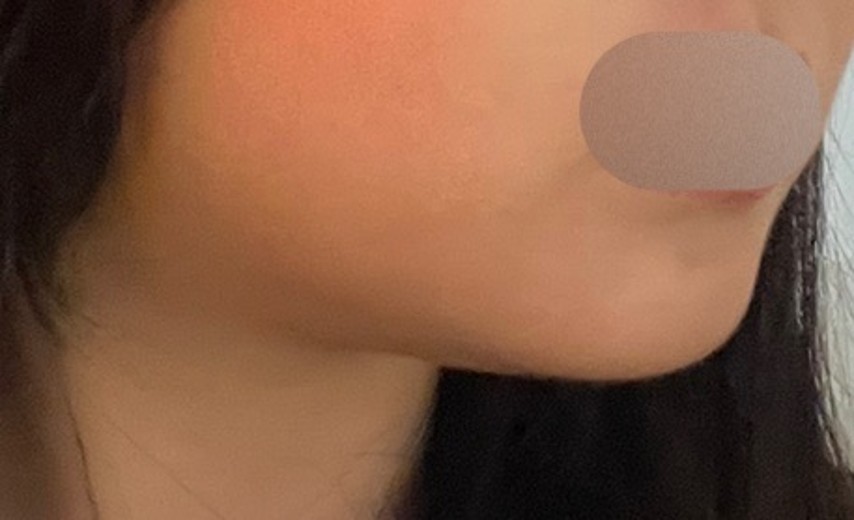 after photo: 인모드리프팅